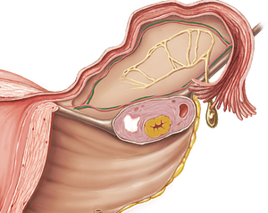 Ovarian vein (#10453)