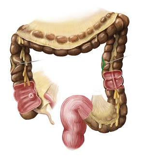 Mesocolic tenia (#9406)