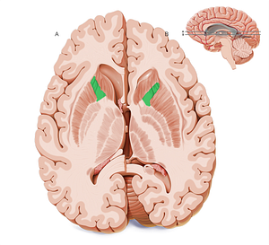 Anterior limb of internal capsule (#20573)