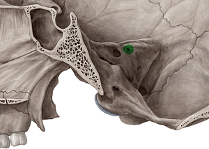 External opening of vestibular aqueduct (#750)