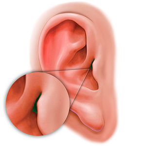 Supratragic notch of auricle (#20195)