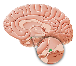 Infundibular recess of third ventricle (#8843)