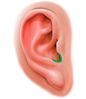 Intertragic incisure of auricle (#20192)