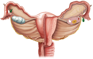 Vesicular appendage of epoophoron (#798)