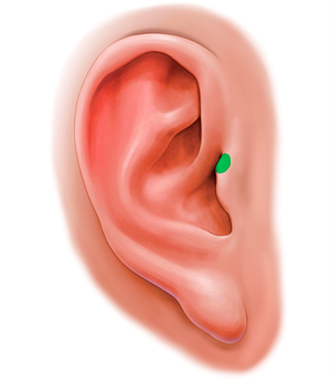 Supratragic tubercle of auricle (#20193)
