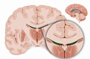 Body of lateral ventricle (#11865)