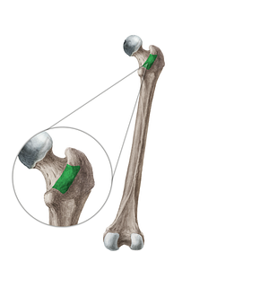 Intertrochanteric crest of femur (#19954)