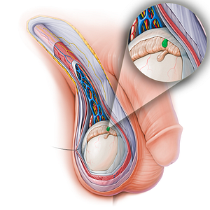 Appendix of epididymis (#15144)