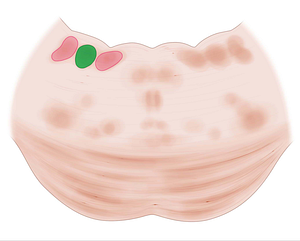 Lateral vestibular nucleus (#7272)