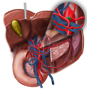 Common hepatic artery (#1333)