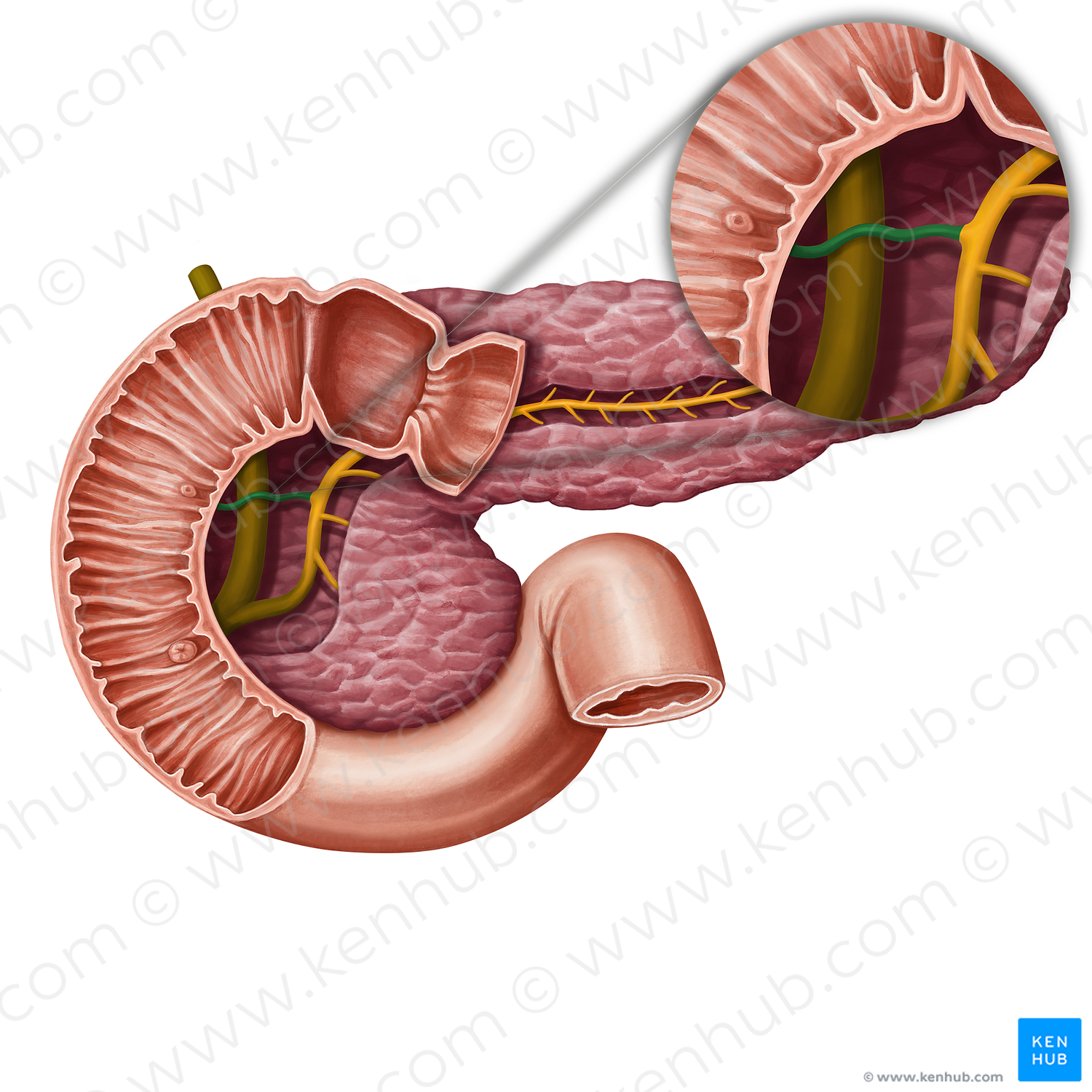 Accessory pancreatic duct (#13935)
