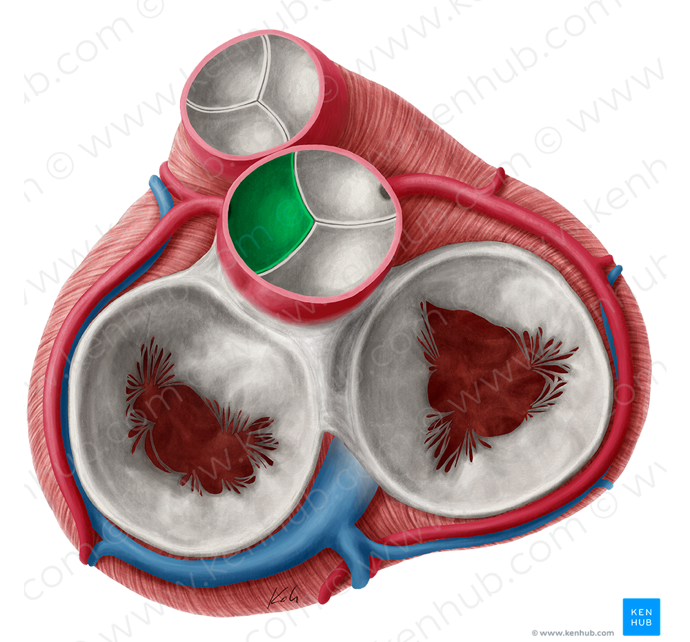 Left coronary leaflet of aortic valve (#9926)