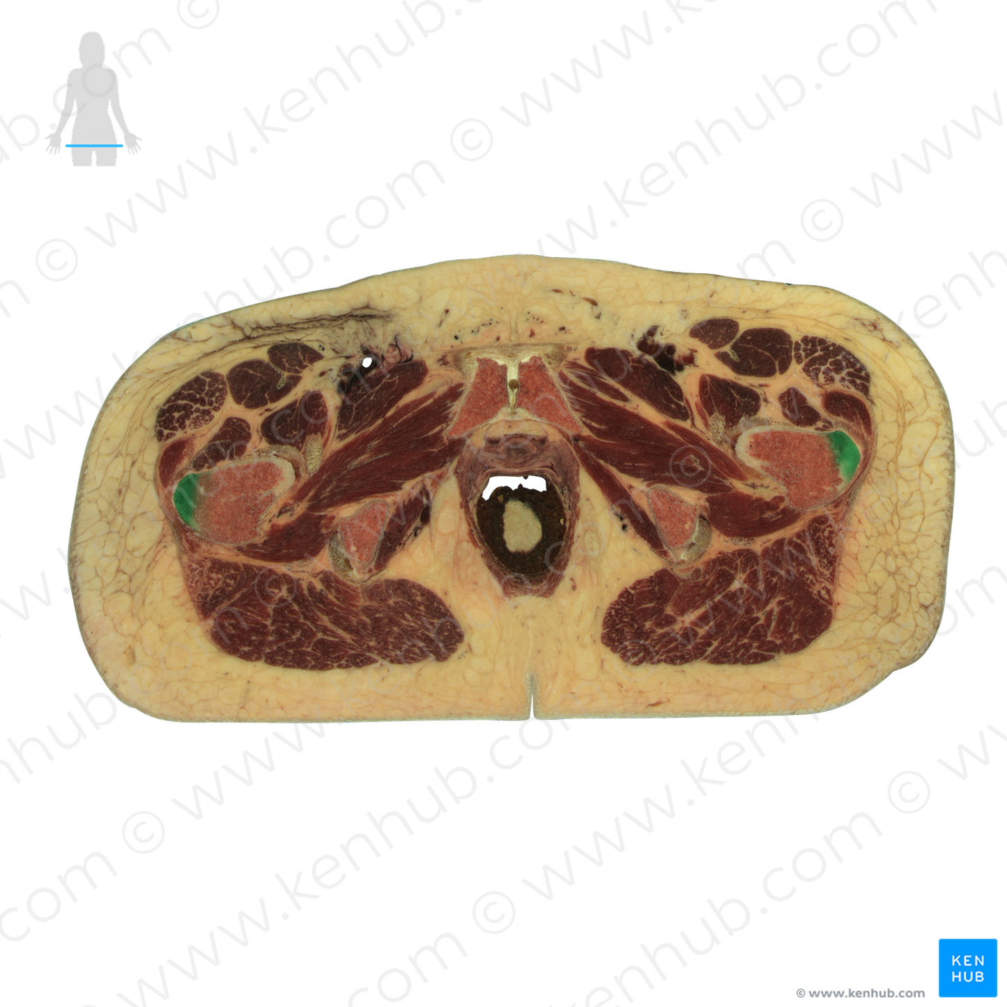 Greater trochanter of femur (#9573)