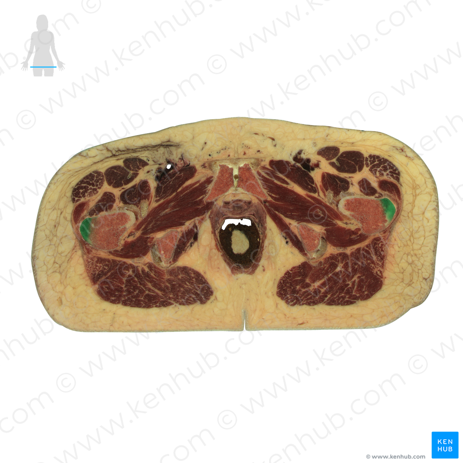 Greater trochanter of femur (#9573)