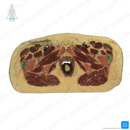 Greater trochanter of femur (#9573)