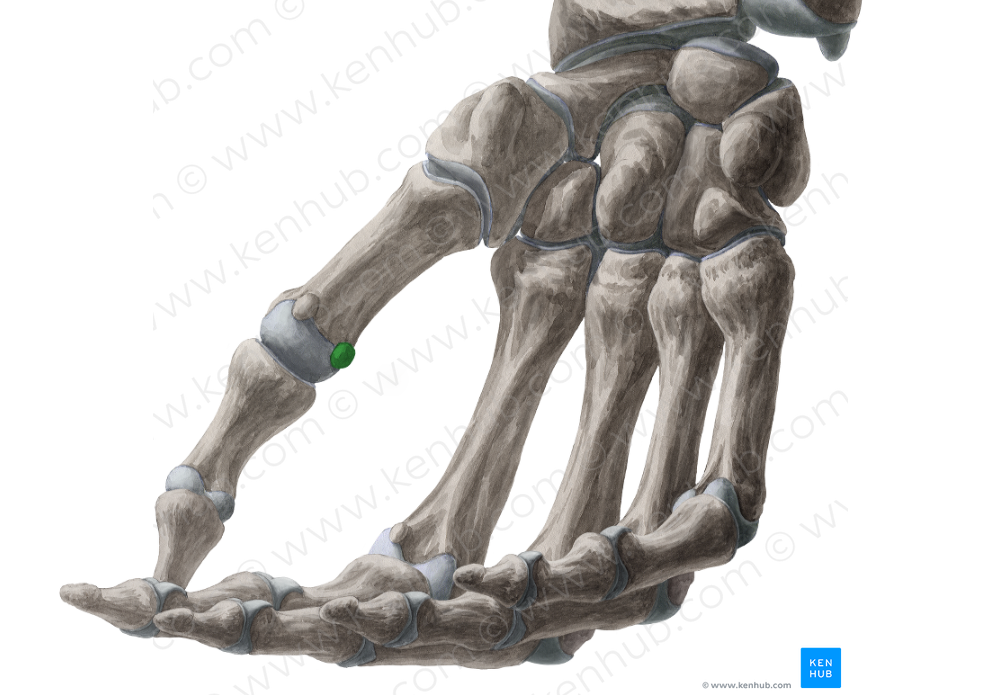 Ulnar sesamoid bone of metacarpophalangeal joint of thumb (#7508)