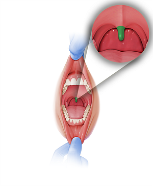 Uvula of palate (#9874)