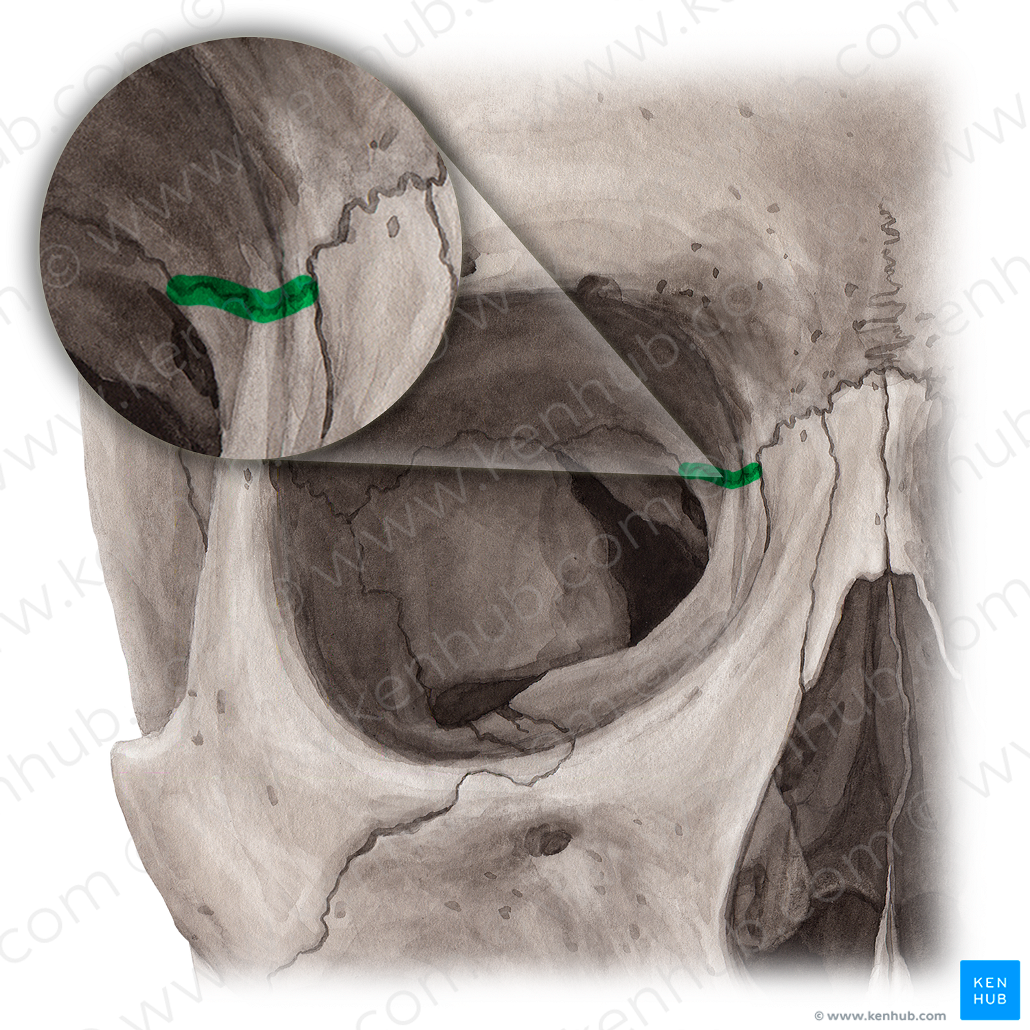 Frontoethmoidal suture (#21460)