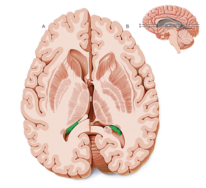 Choroid plexus of lateral ventricle (#7978)