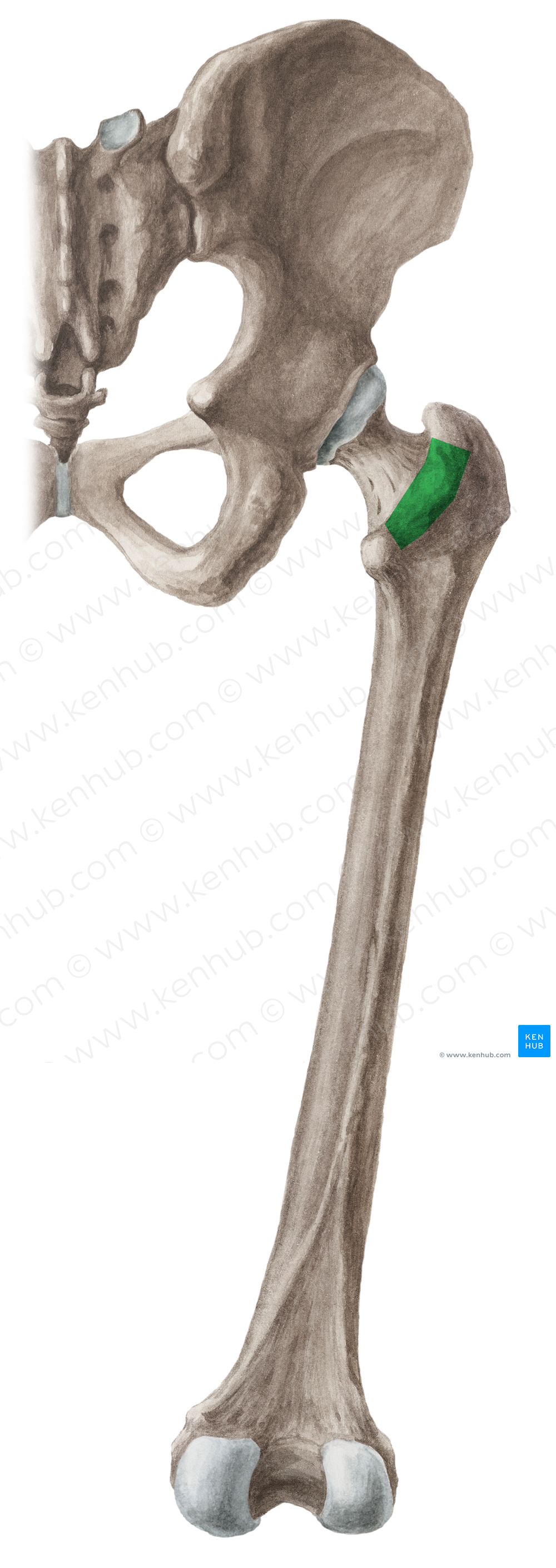 Intertrochanteric crest of femur (#3114)