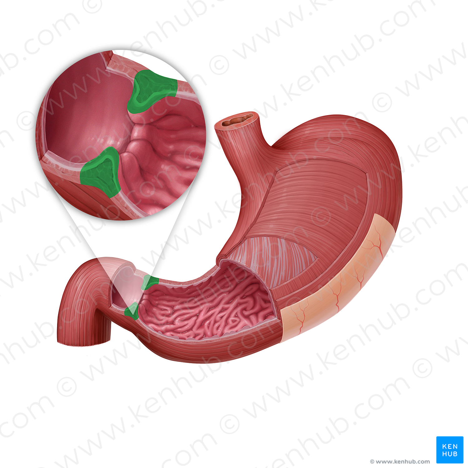 Pyloric sphincter (#21597)