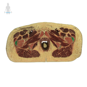 Greater trochanter of femur (#9573)