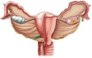 Uterosacral ligament (#4617)