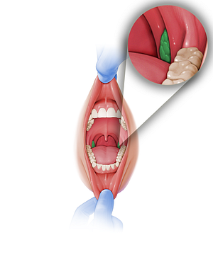 Palatine tonsil (#9473)