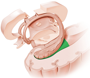 Temporal horn of lateral ventricle (#2877)