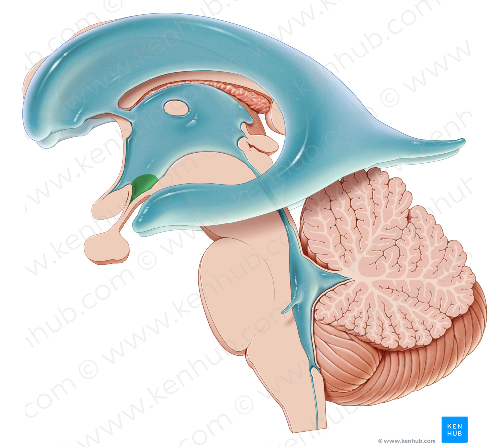 Infundibular recess of third ventricle (#8842)