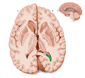 Occipital horn of lateral ventricle (#2874)