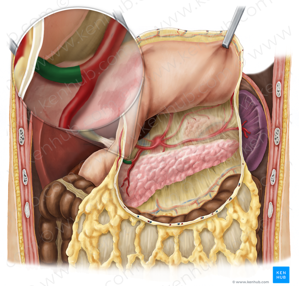 Right gastroomental artery (#1304)