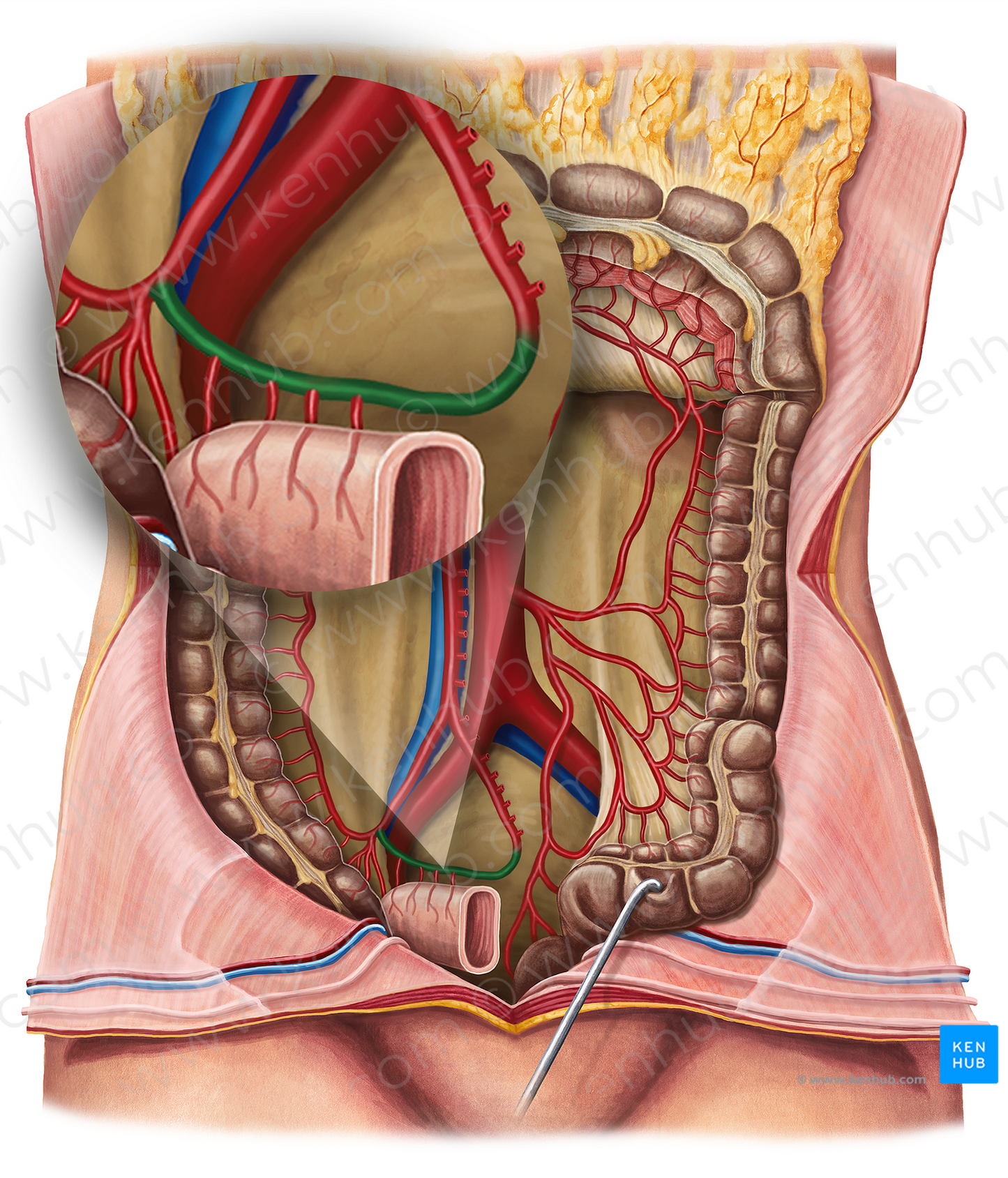 Ileal branch of ileocolic artery (#20612)