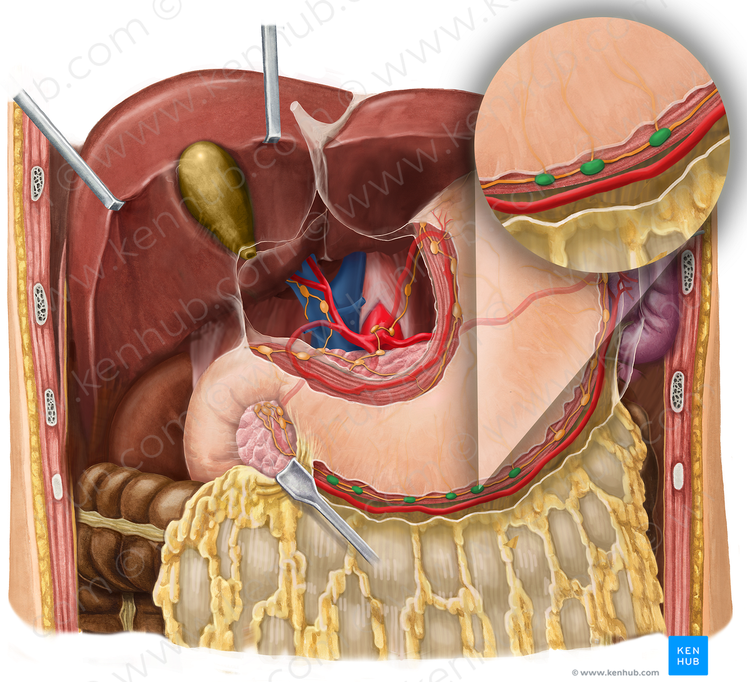 Right gastroomental lymph nodes (#7001)