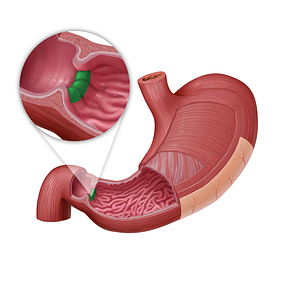 Pyloric orifice (#21593)