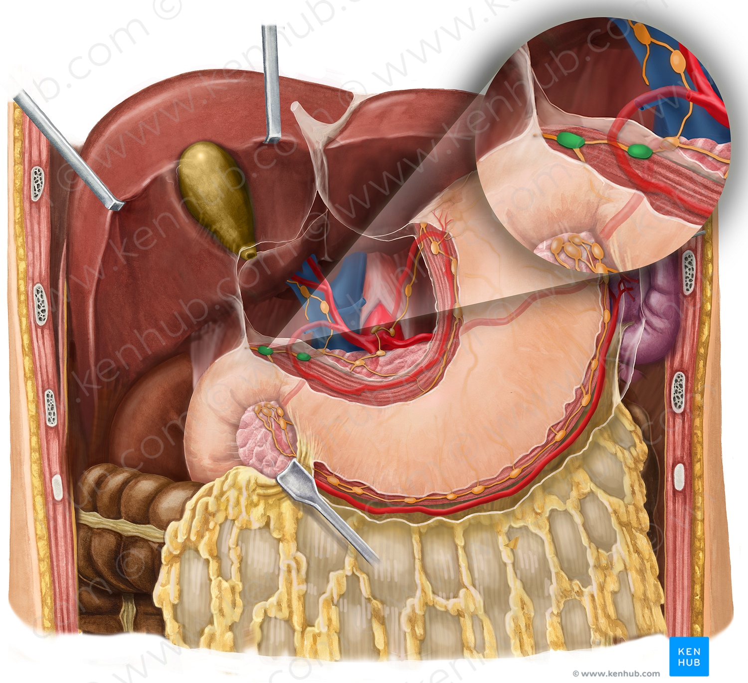 Suprapyloric lymph nodes (#7119)