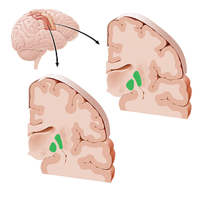 Globus pallidus (#21170)