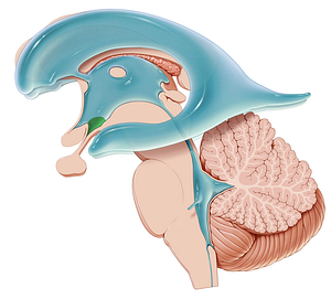 Infundibular recess of third ventricle (#8842)