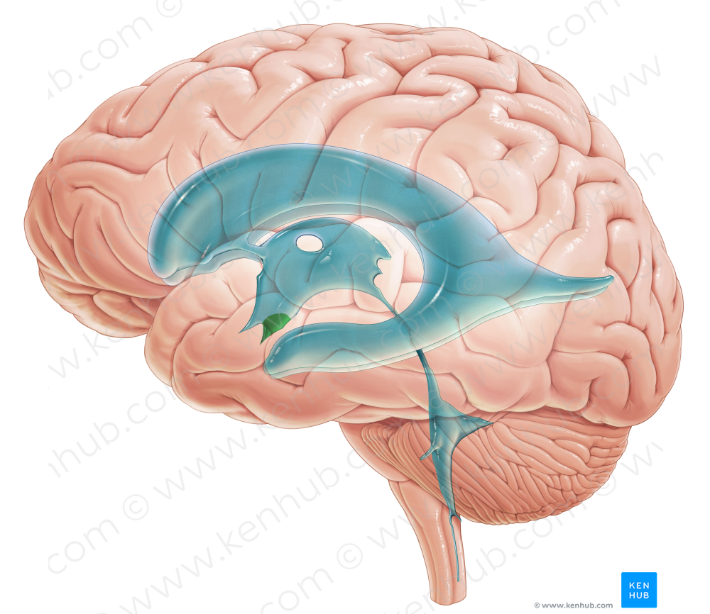 Infundibular recess of third ventricle (#8845)