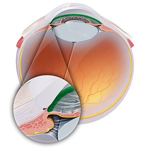 Iridocorneal angle (#20163)