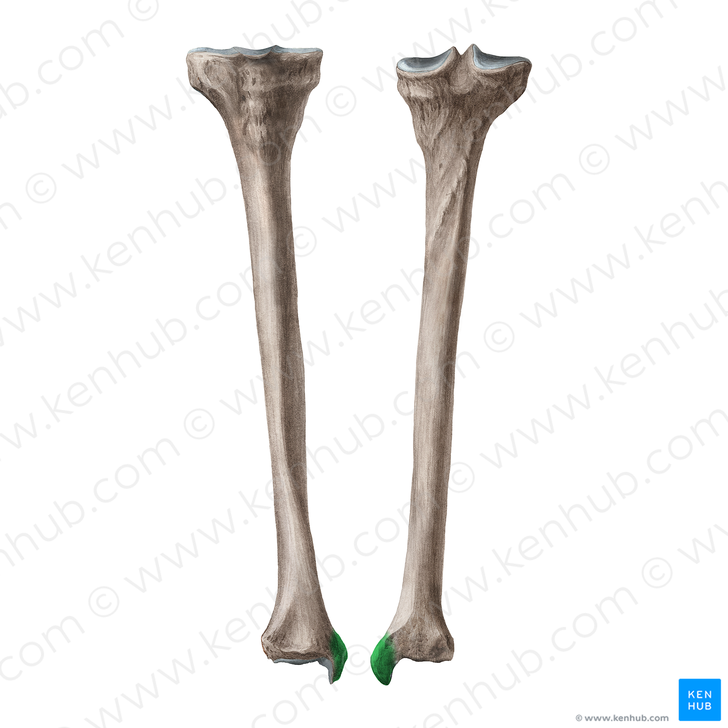 Medial malleolus of tibia (#21950)