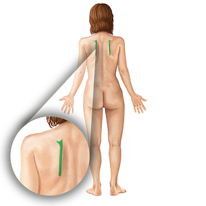 Medial border of scapula (#19772)