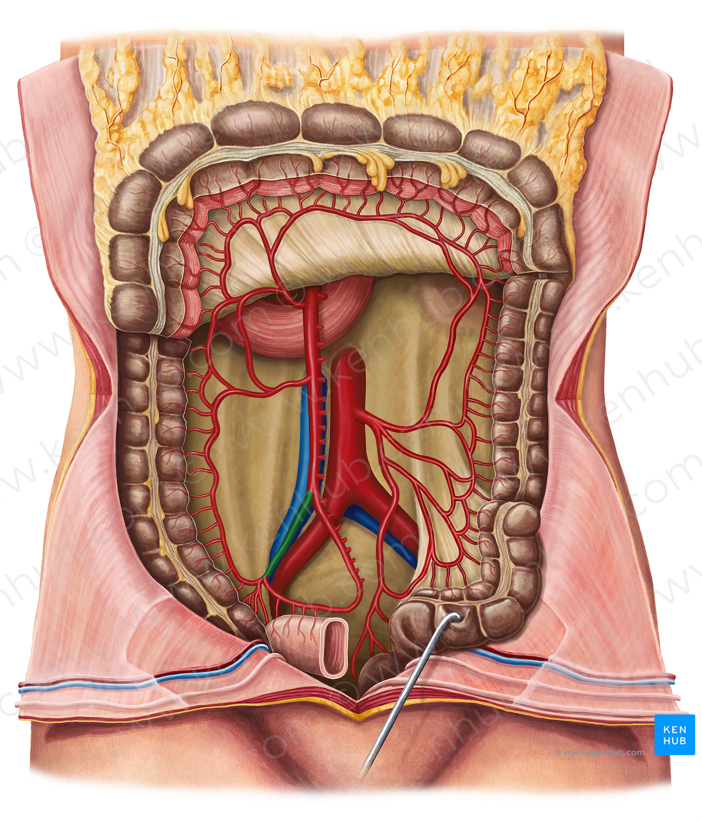 Ileocolic artery (#1363)