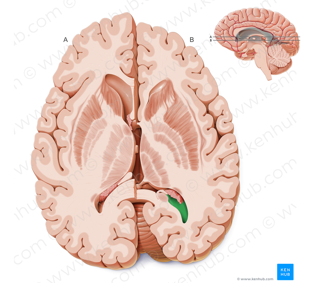 Occipital horn of lateral ventricle (#2874)